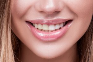 Split image of smile before and after teeth whitening