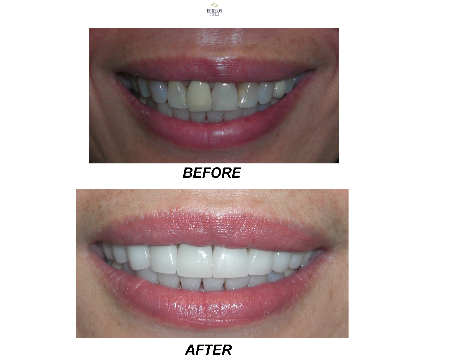 Before-and-After-dental-whitening