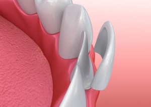Animation of dental veneer cap