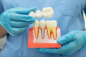 A dentist holding an example of a dental bridge.