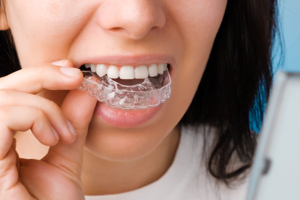 Invisalign for adults